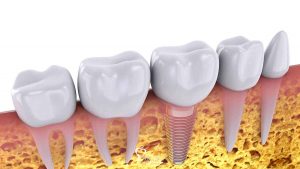 dental-implants-stop-bone-resorption-featured
