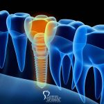 do-dental-implants-fail-featured