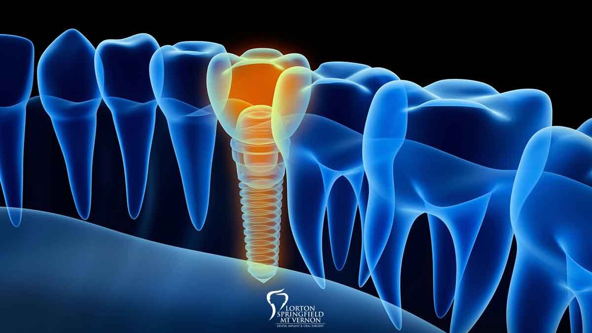 Do Dental Implants Fail?