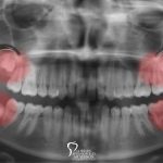 How Wisdom Tooth Extraction Contributes to Optimal Oral Health featured