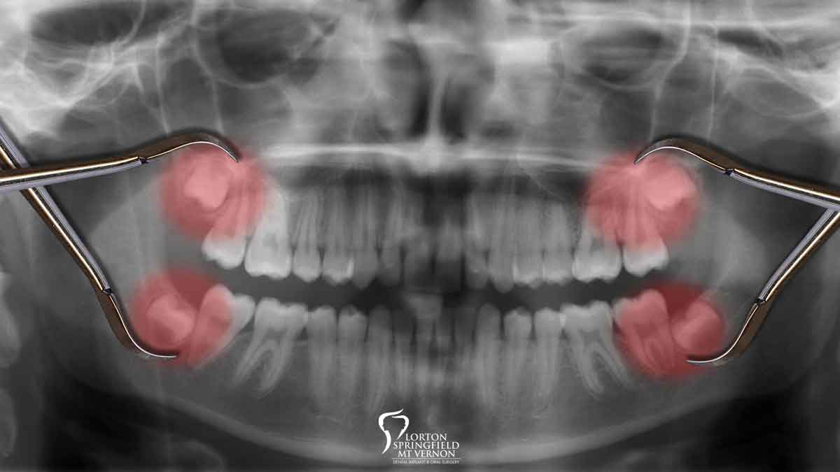 How Wisdom Tooth Extraction Contributes to Optimal Oral Health