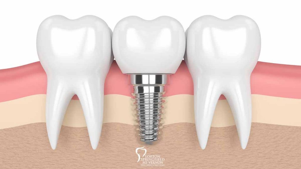 Common Dental Implant Questions featured