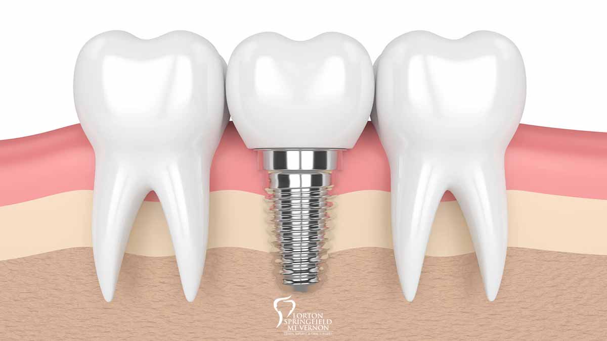 Common Dental Implant Questions