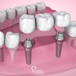 Comparing Traditional and Implant Bridges featured