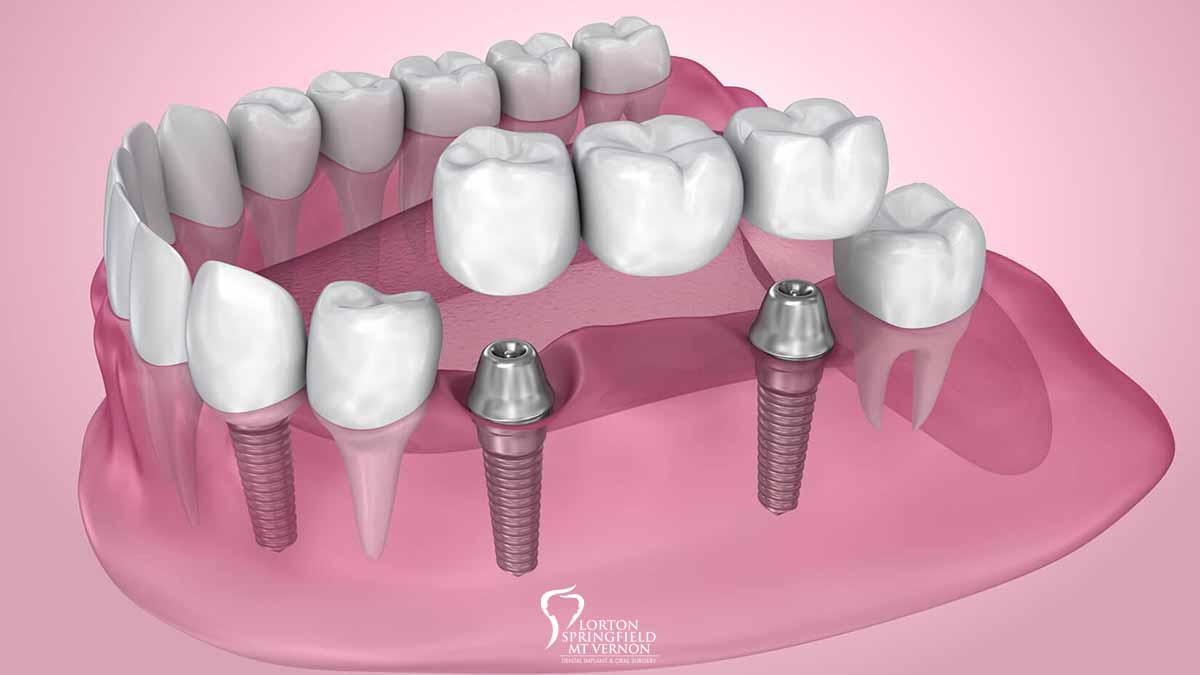 Comparing Traditional and Implant Bridges