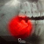 Facts About Wisdom Teeth Extraction featured