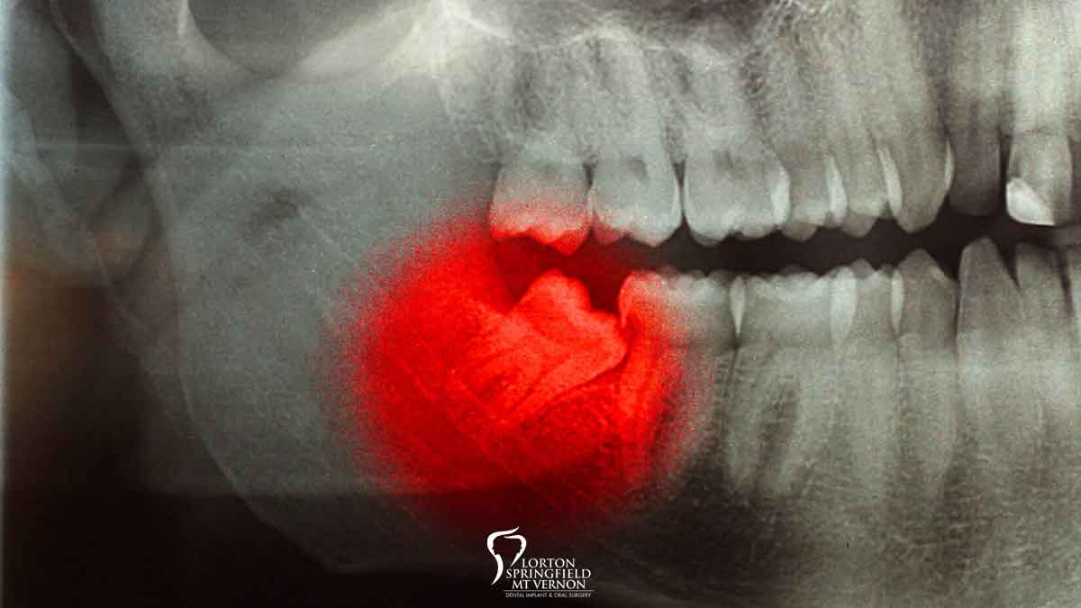 Facts About Wisdom Teeth Extraction