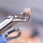 When Is Tooth Extraction Necessary featured