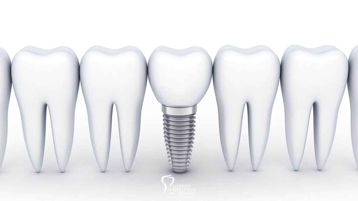 Snap-On Smile vs. Permanent Implant Dentures