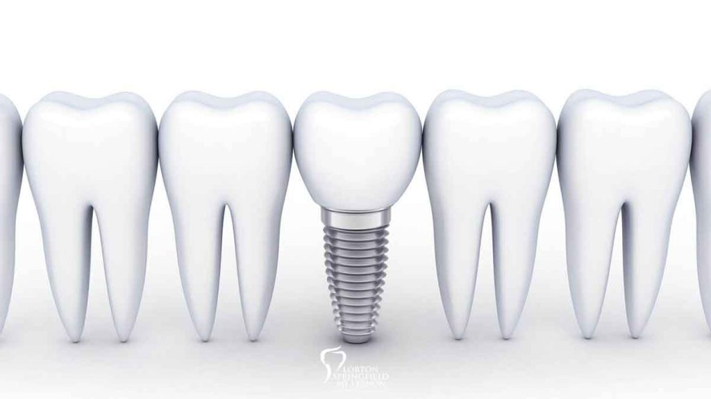 dental-implants-vs-bridges-featured