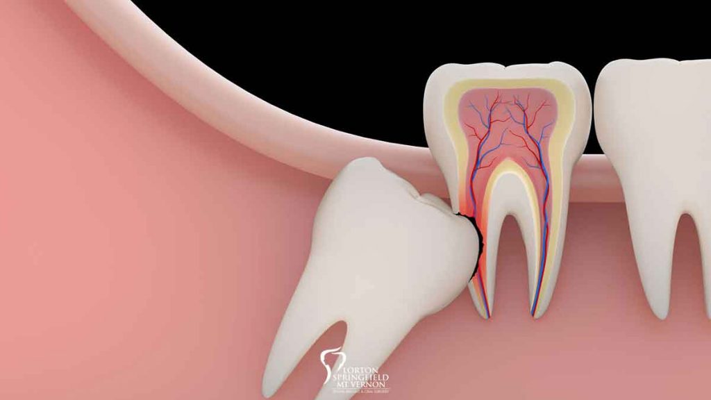 wisdom-tooth-problems-featured