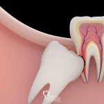 wisdom-tooth-problems-featured