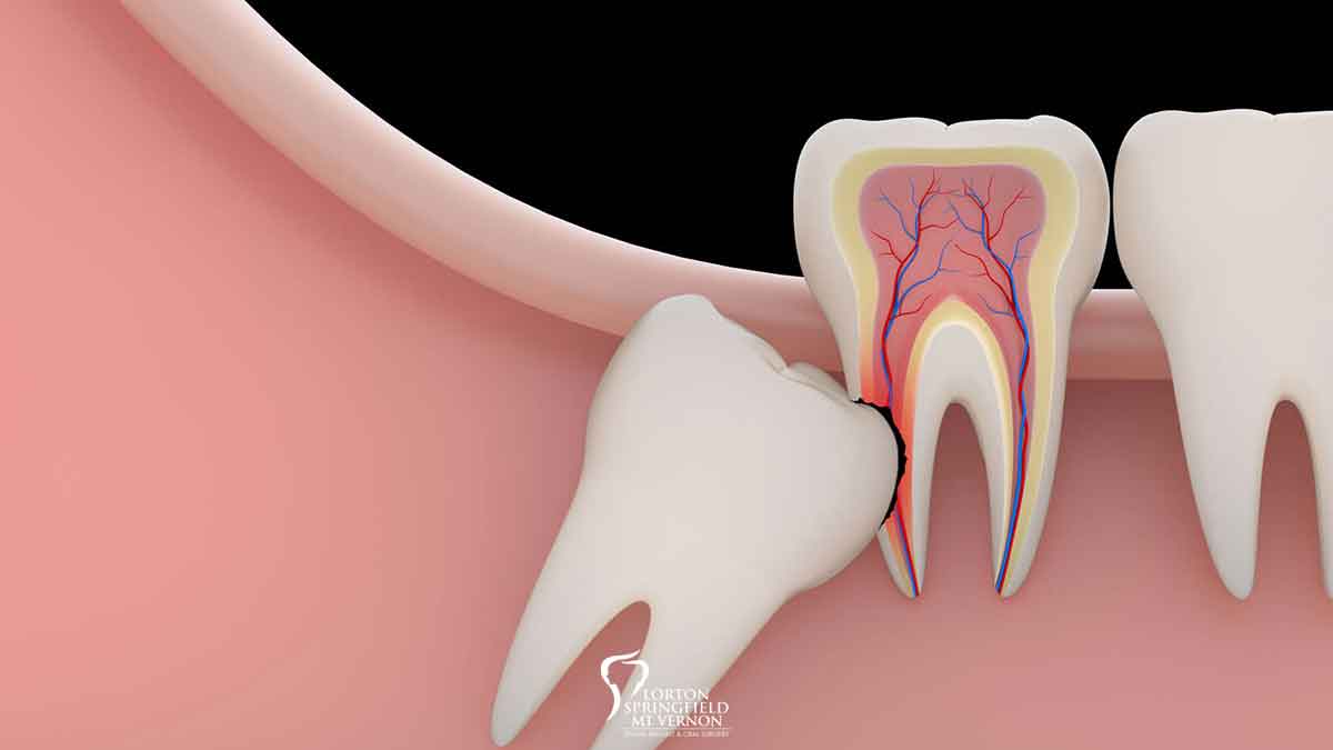 Benefits of Having Your Wisdom Teeth Extracted