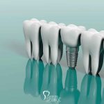 Myths and Misconceptions of Dental Implants featured