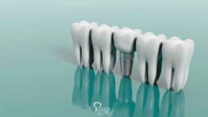 Myths and Misconceptions of Dental Implants featured