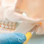 Treating TMJ Disorder with Oral Surgery featured