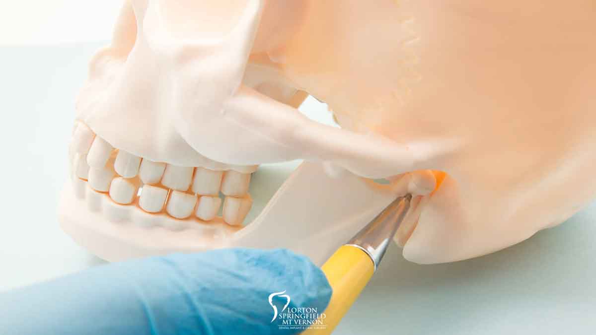 Treating TMJ Disorder with Oral Surgery