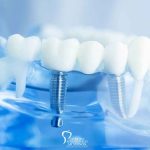 Using Dental Implants to Treat Periodontal Disease featured