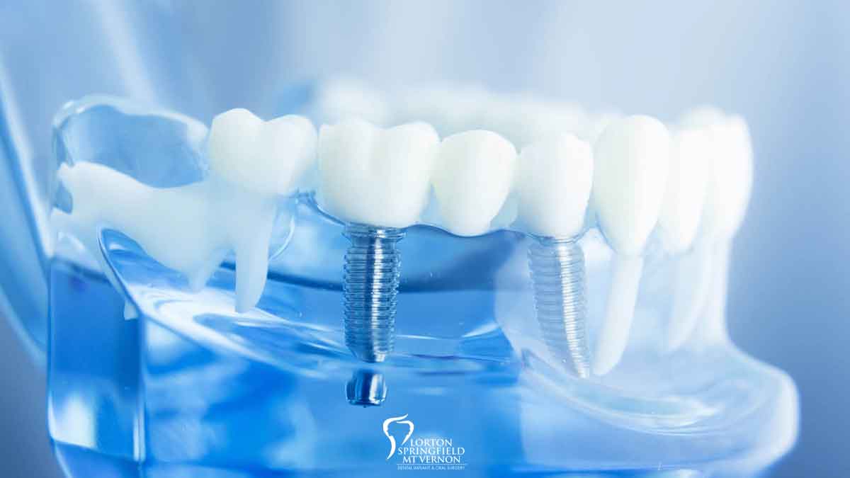 Using Dental Implants to Treat Periodontal Disease