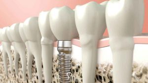 osseointegration-of-dental-implants-featured