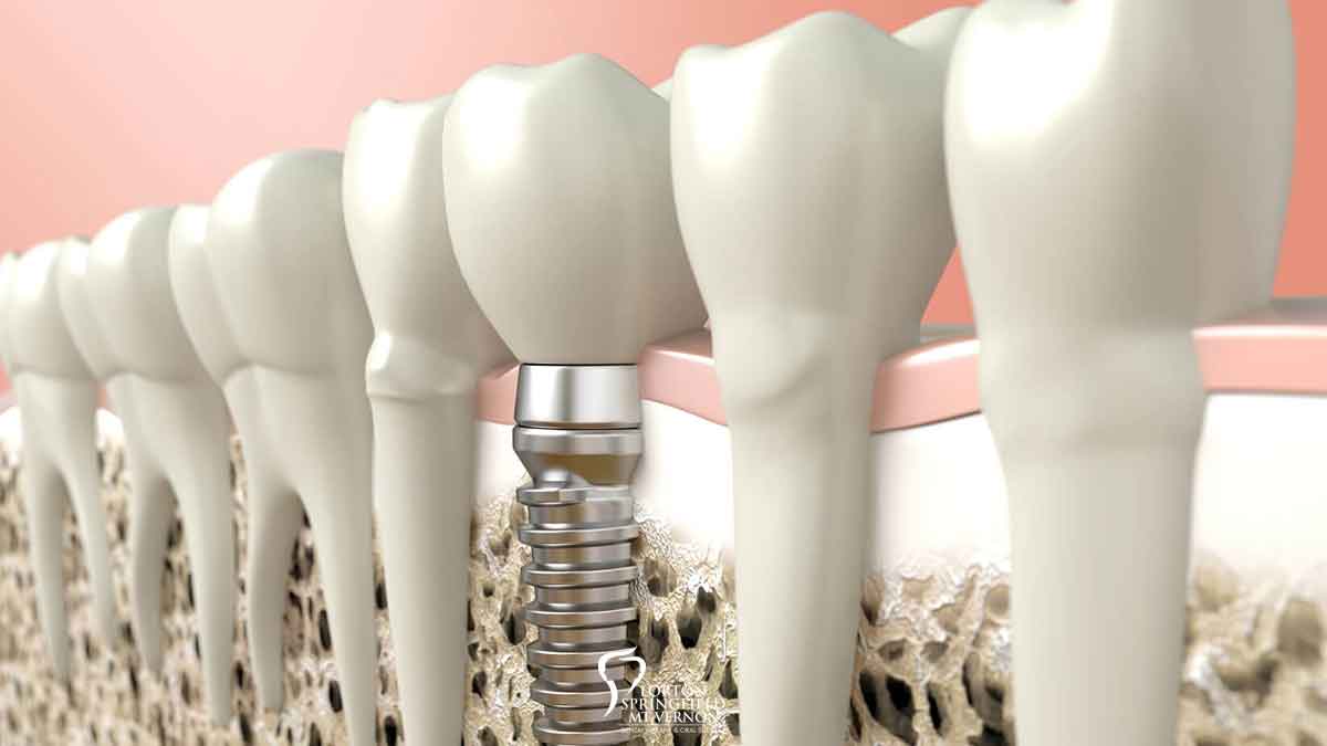 What is Osseointegration?