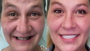 Full Face - Before and After New Teeth With Dental Implants
