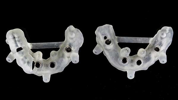 3d-printed-implant-guides-for-accurate-implant-placement