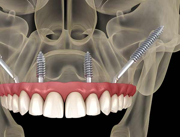 4-dental-implants-zygomatic