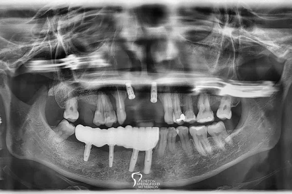 CT-scan-hybrid-dentures-dental-implants-2