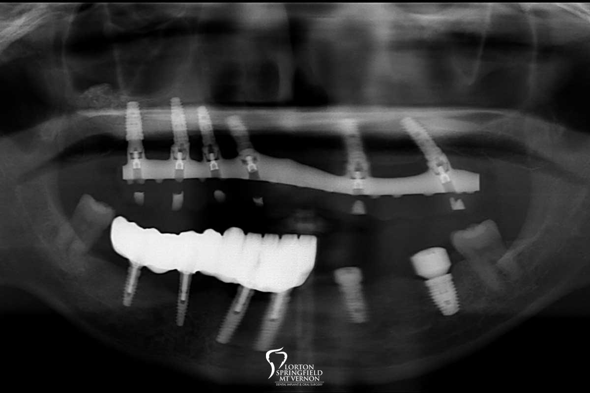 CT-scan-hybrid-dentures-dental-implants