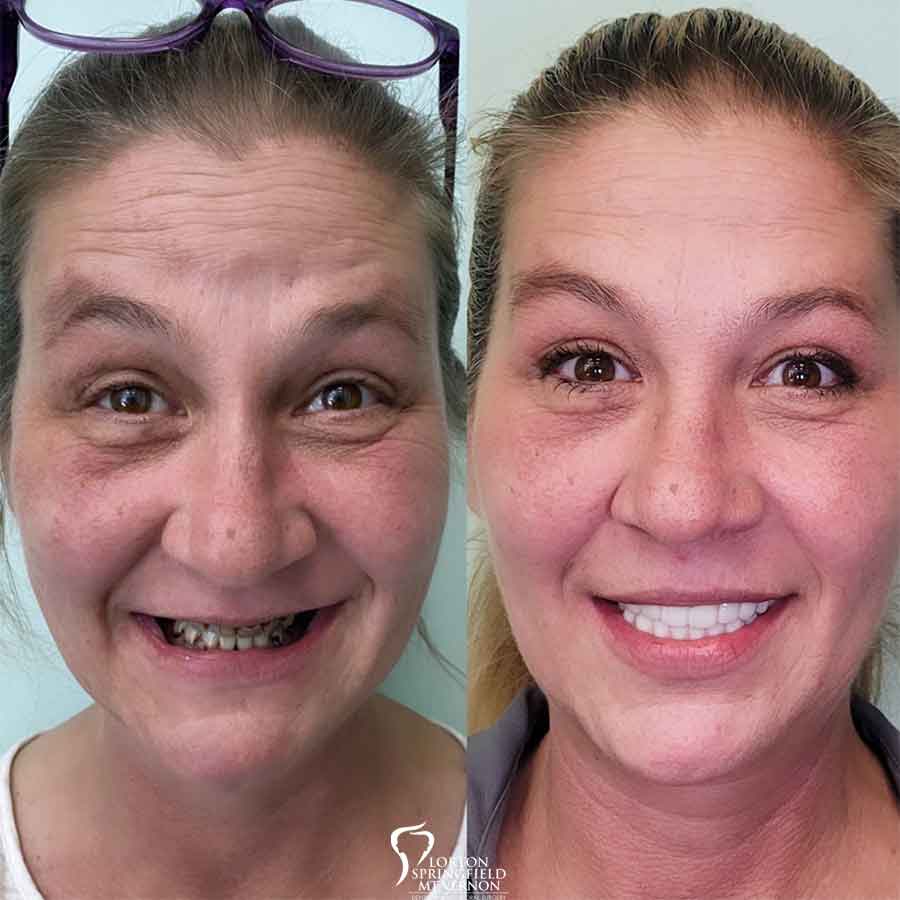 Full Face - Before and After New Teeth With Dental Implants