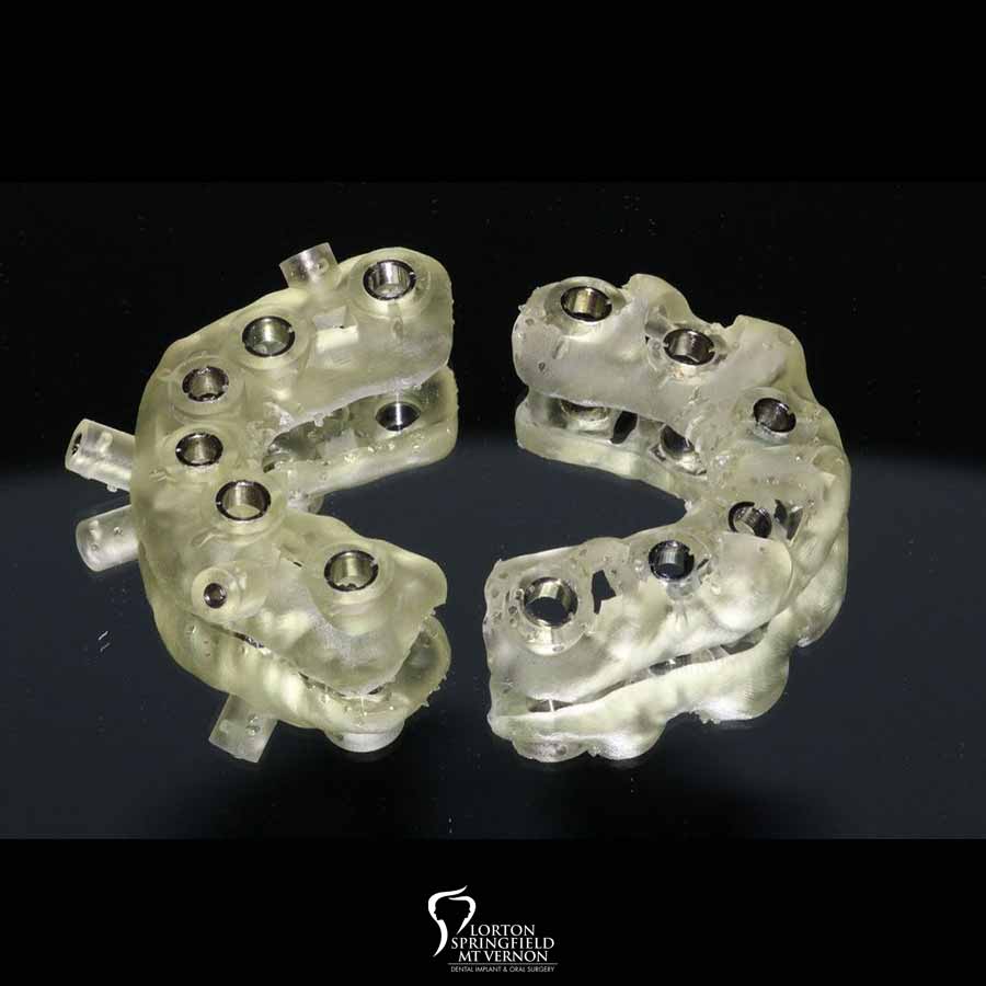 Full-Mouth-Restoration-implant-upper-lower-hybrid-dentures