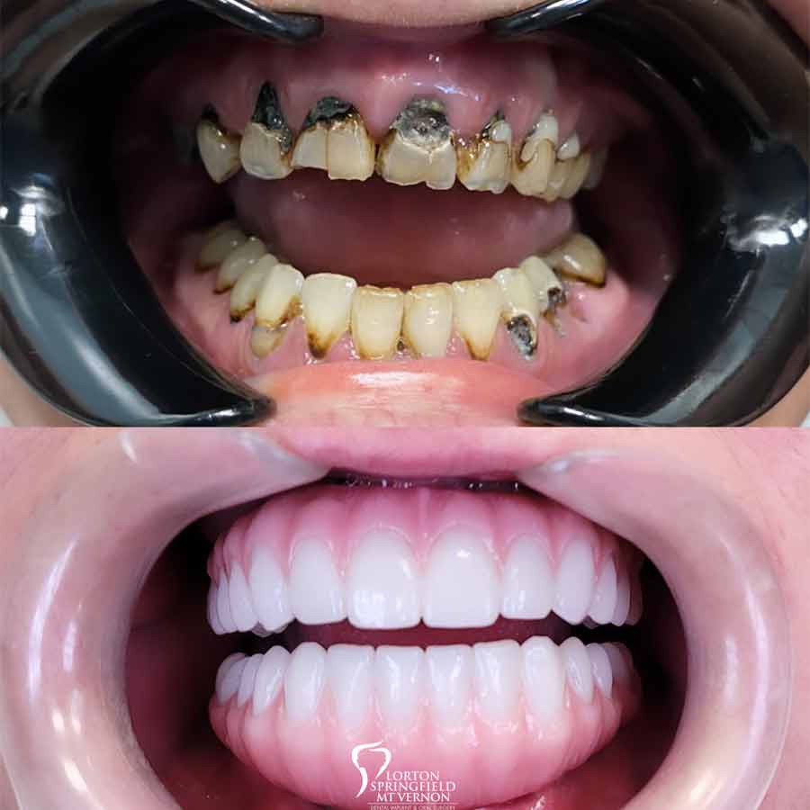 Teeth Closeup - Before and After New Teeth With Dental Implants