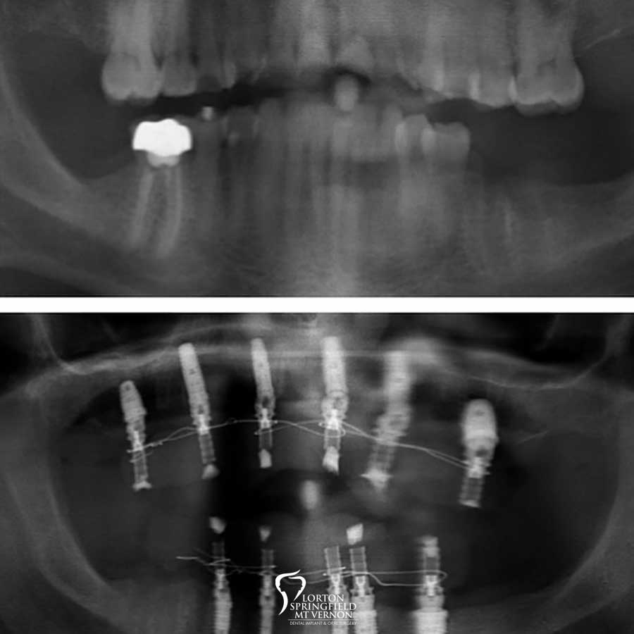 X-Ray-Full-Mouth-Restoration-upper-lower-hybrid-dentures