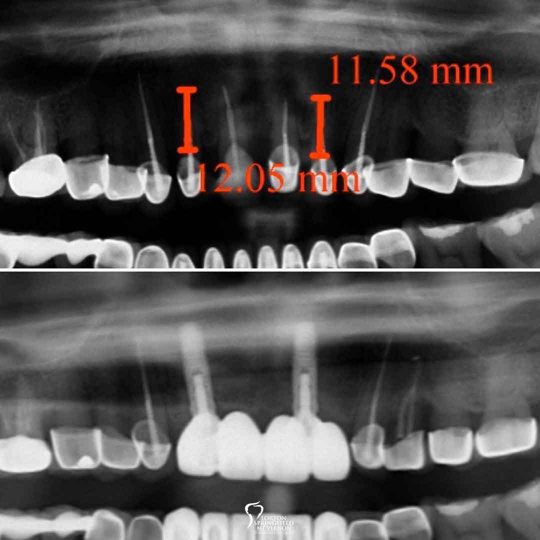 X-Ray-before-after-implant-supported-fixed-bridge