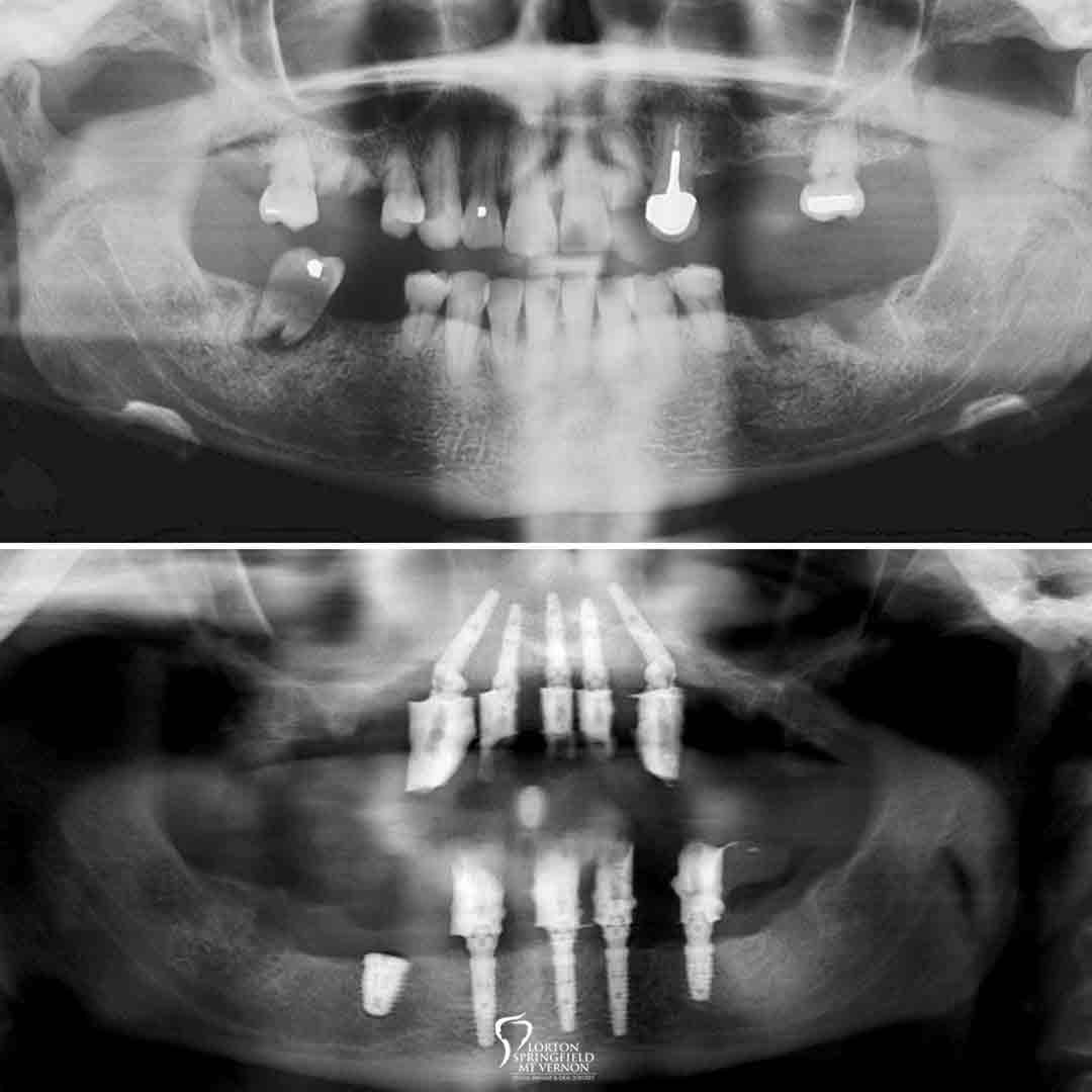X-Ray-before-after-non-removable-hybrid-dentures-dental-implants