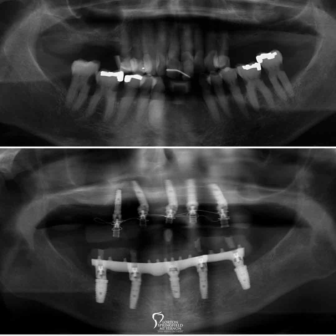 X-Ray-before-after-upper-hybrid-conversion-dental-implants