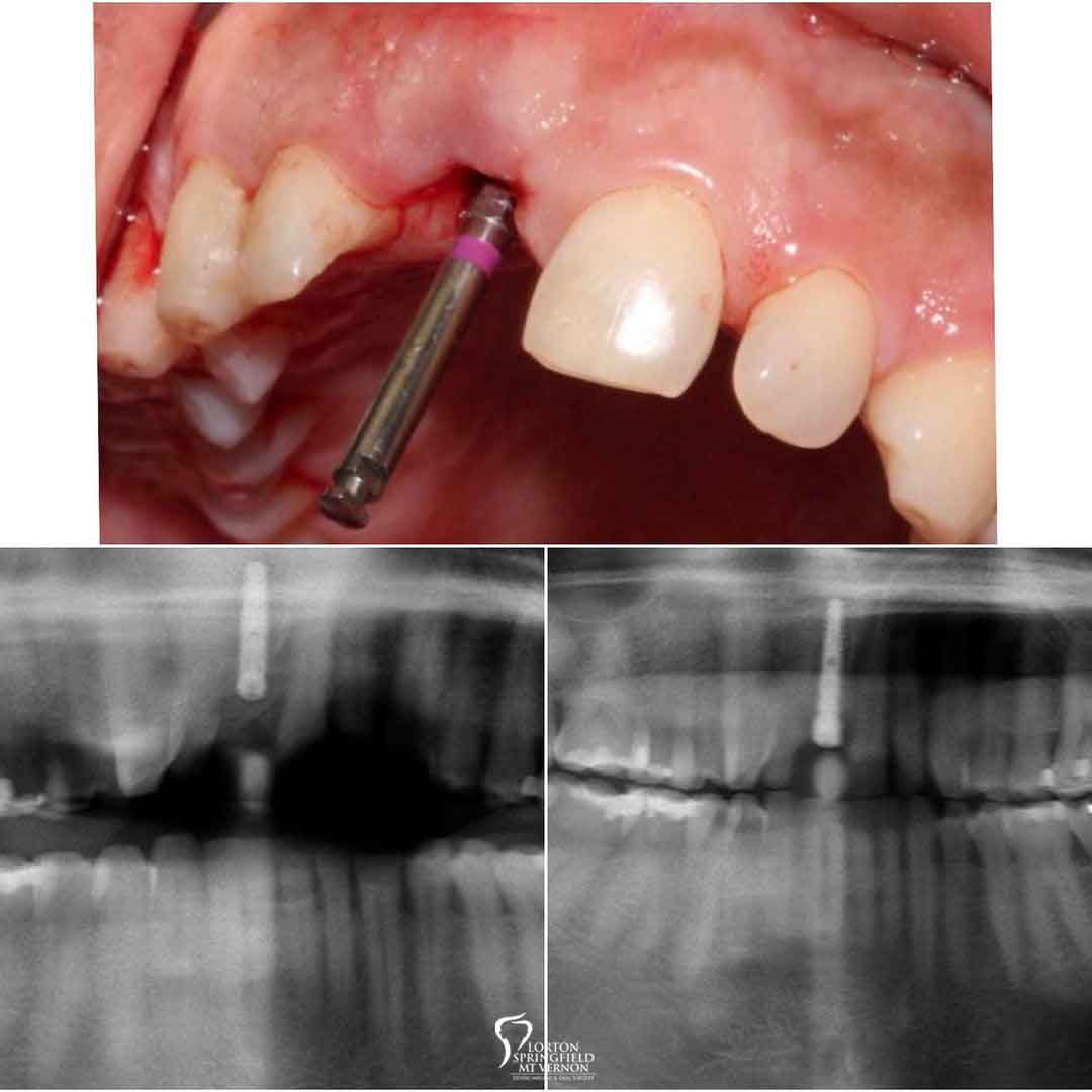 X-Ray-non-restorable-tooth-replaced-dental-implant