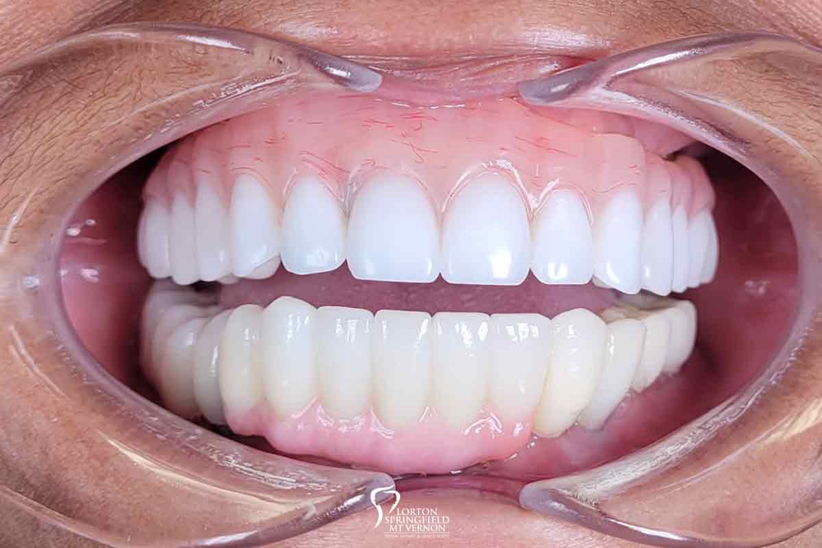 after-hybrid-dentures-dental-implants