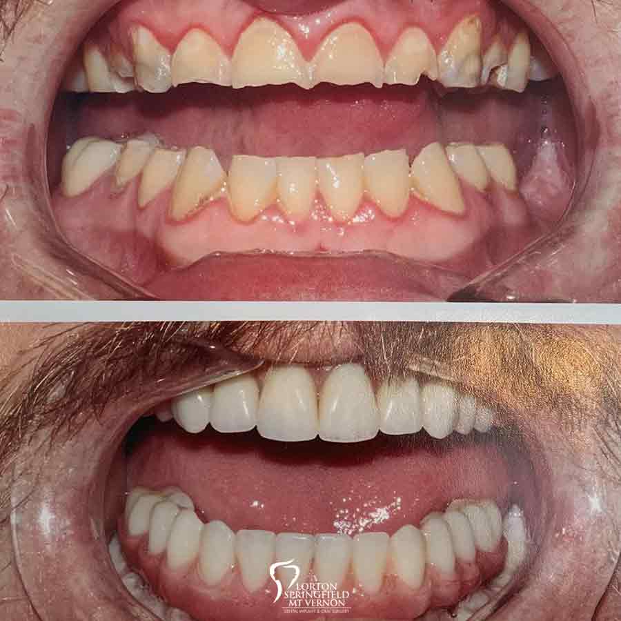 before-after-Full-Mouth-Restoration-hybrid-dentures-implants