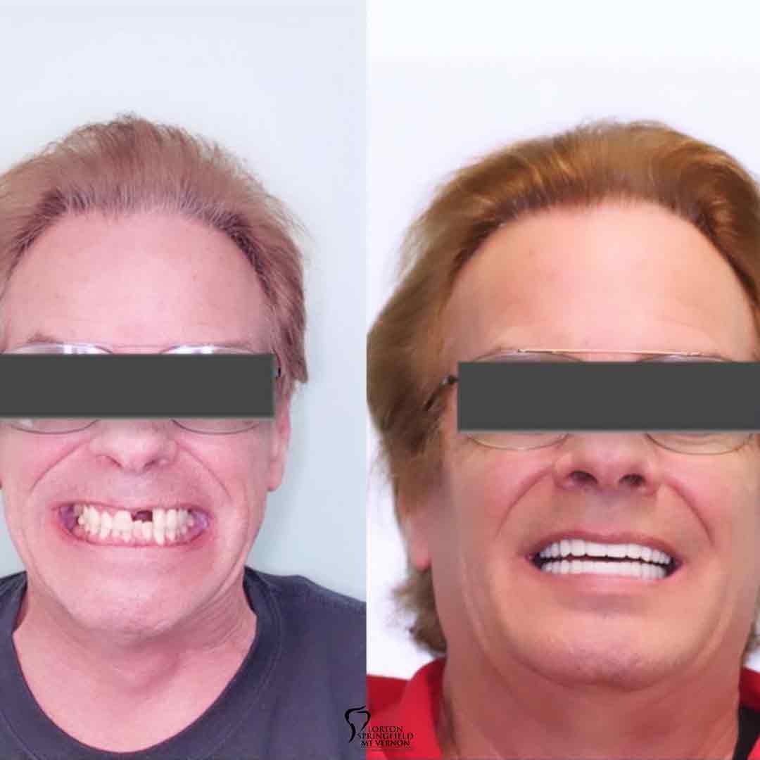 before-after-implant-supported-dentures