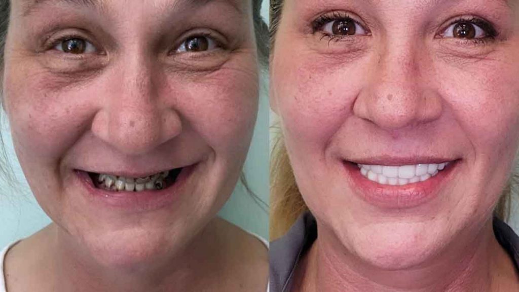 before-after-new-teeth-oral-surgery