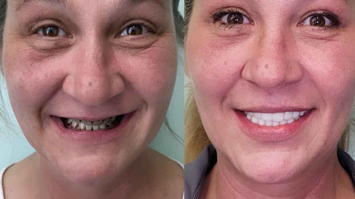 tooth implant before after