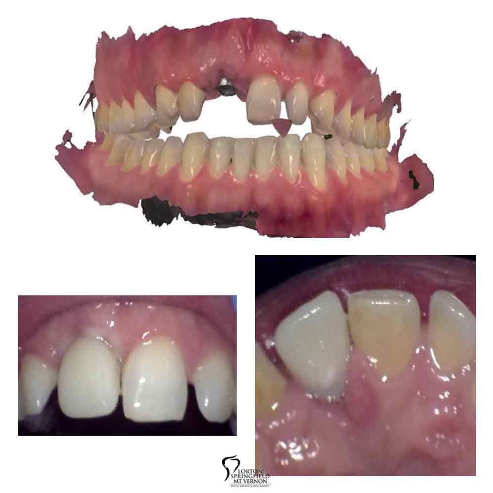 before-after-non-restorable-tooth-replaced-dental-implant-3-images
