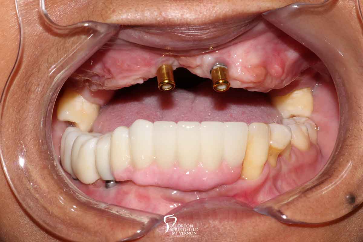before-hybrid-dentures-dental-implants