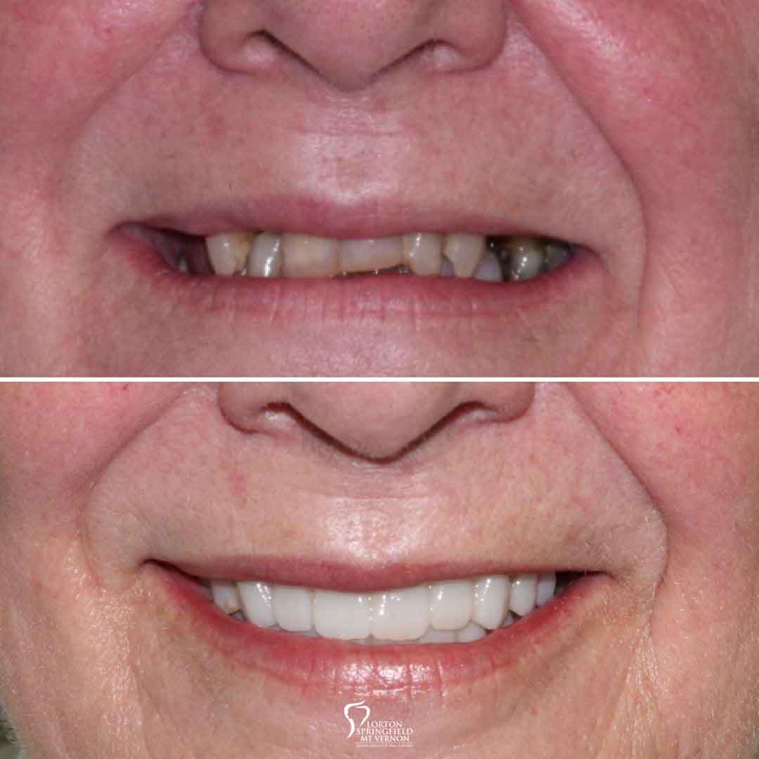 closeup-before-after-complete-rehabilitation-dental-implants
