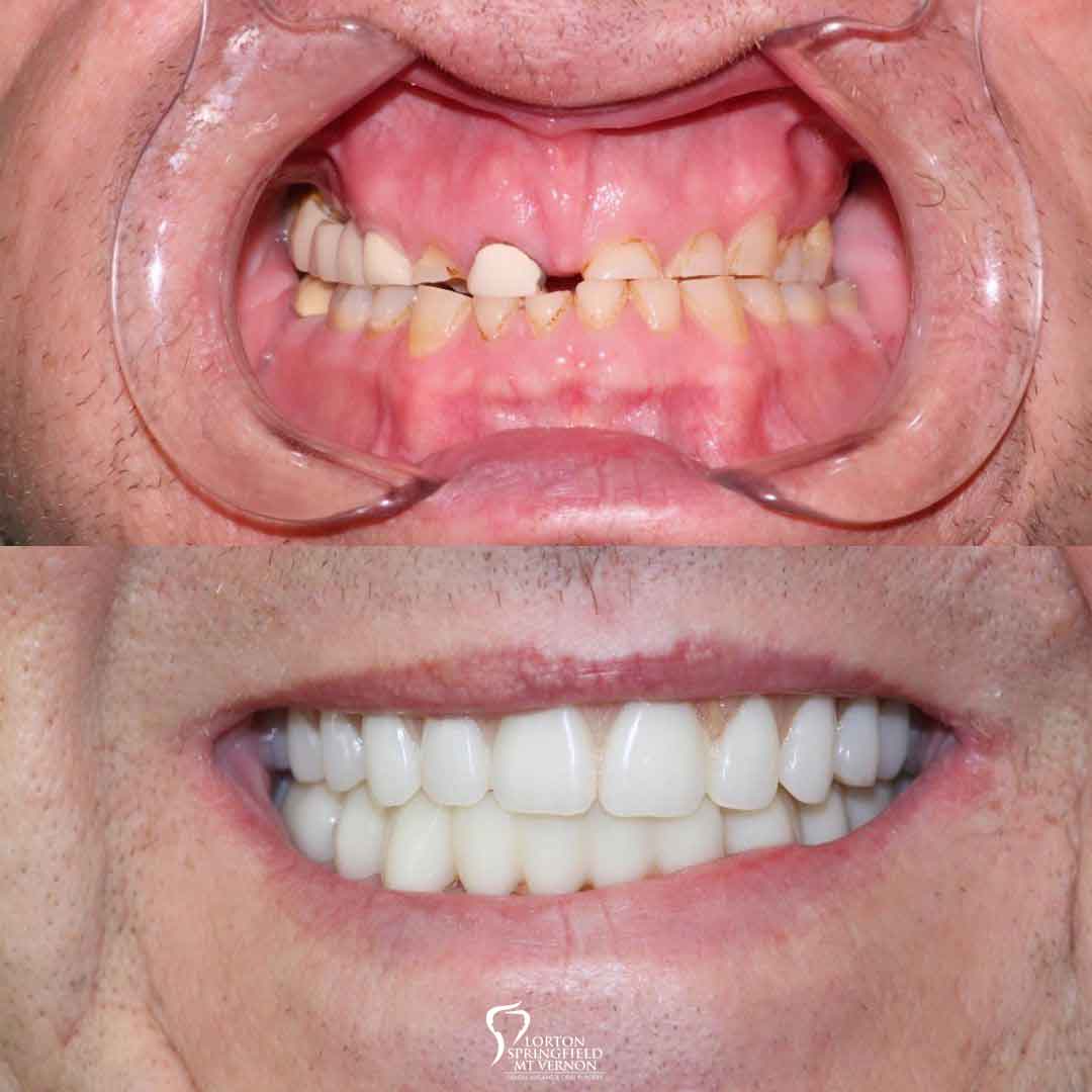 closeup-before-after-hybrid-denture-smile-makeover