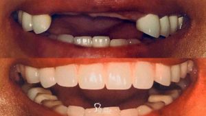 closeup-before-after-implant-supported-fixed-bridge-featured