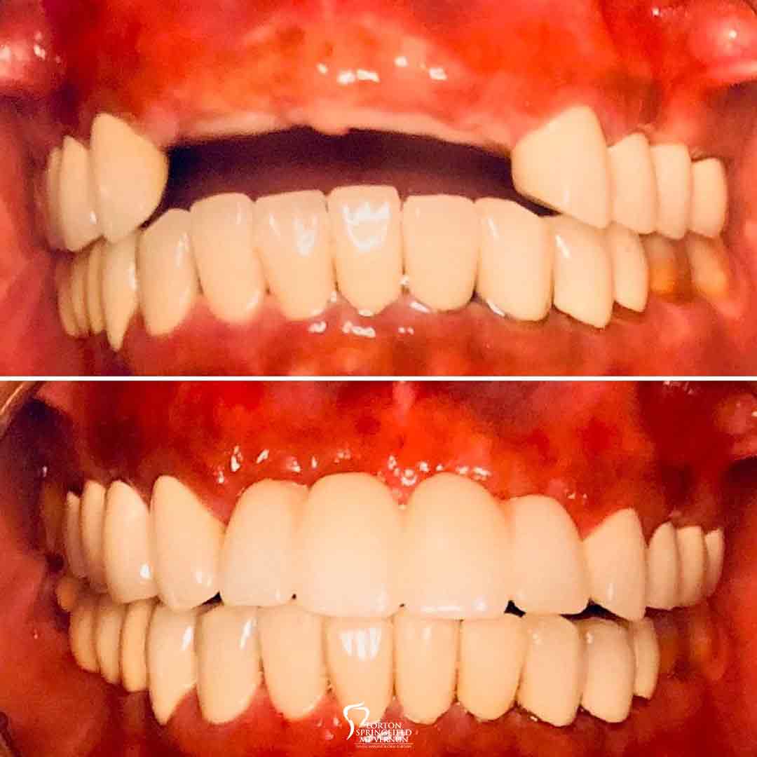 closeup-before-after-implant-supported-fixed-bridge