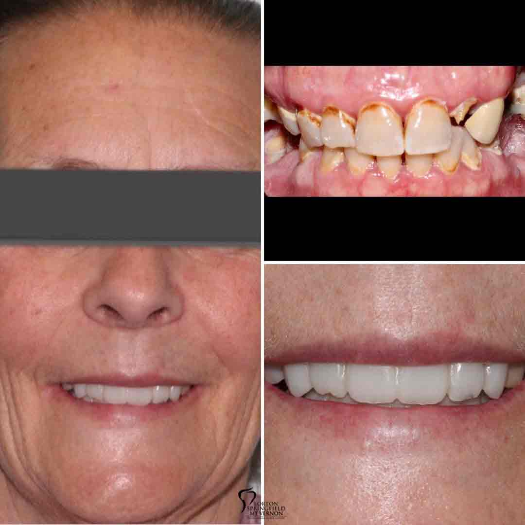 closeup-before-after-non-removable-hybrid-dentures-dental-implants